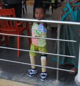 Elizabeth's Legacy of Hope - Valentine amputee India - helping child amputees walk
